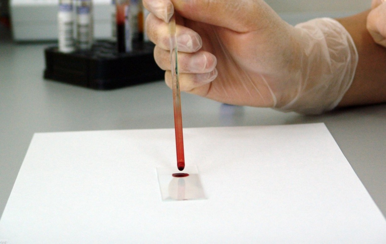 Ранняя диагностика меланомы: как самостоятельно оценить родинки и не упустить угрозу