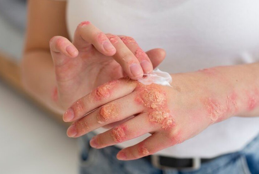 Учёные связали тип белка в рационе с тяжестью течения псориаза